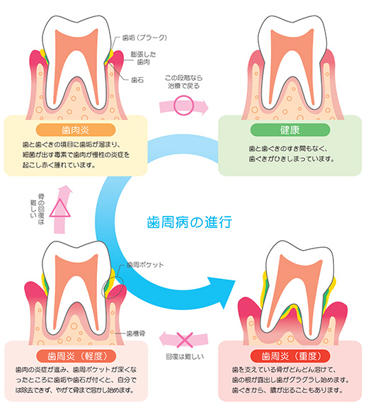 歯周病が進行するメカニズム