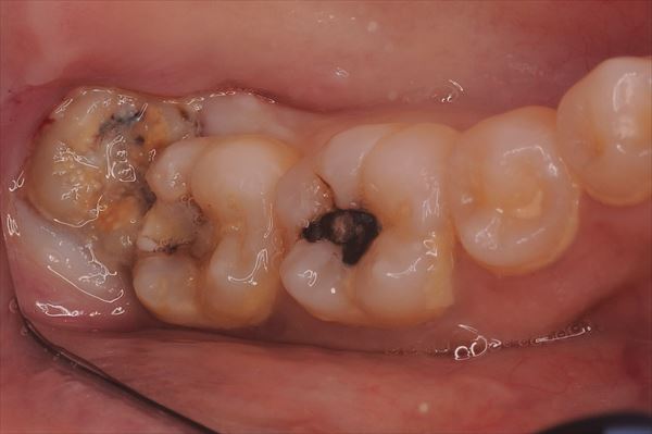 奥歯の腫れや痛みの原因は智歯周囲炎が考えられます
